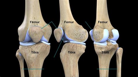 Tibia Anel De Fenda