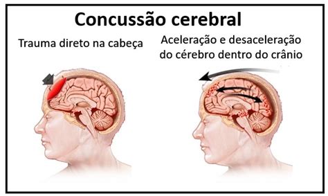 Trauma Na Cabeca E Jogos De Azar